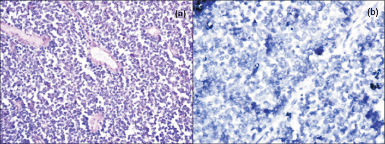 (a). A case of peripheral neuroectodermal tumour (PNET) of kidney in a 15 year old boy (H&Ex100). (b) WT1 immunostaining shows negative results (Immunostain x100).
